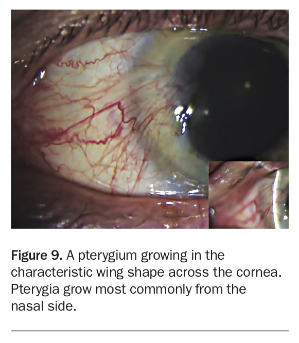 The Red Eye – A Practical Management Approach | Medicine Today